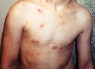 pictures of chickenpox rash
