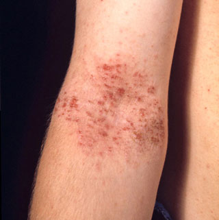 Eczema - Adolescente