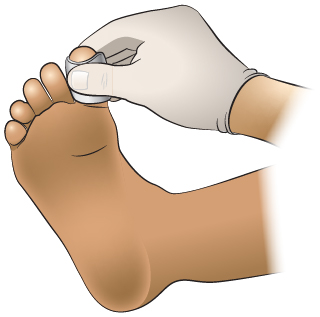Primeros Auxilios: Hemorragia en Un Dedo del Pie