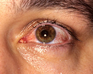 Conjuntivitis viral (ojo rosado)
