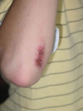<strong>Abrasion on Elbow (3 Days Old)</strong> <p>This scrape (abrasion) near the elbow occurred 3 days ago. The picture shows a scrape that is starting to crust over. </p><p>There are no signs of infection (such as spreading redness, pus).</p>