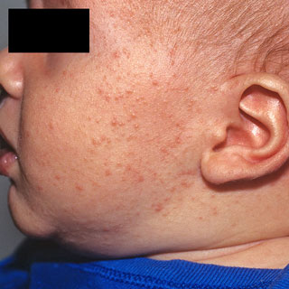 <strong>Baby Acne</strong> <p>This shows baby acne on the cheeks and side of the face.  There are red and white raised bumps.</p>