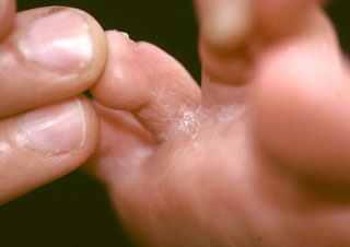 <strong>Athlete's Foot between Toes</strong> <p>Athlete’s foot is often located between the toes.  The skin is dry and cracked.</p>