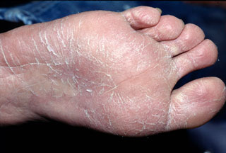 <strong>Athlete's Foot</strong> <p>This shows the bottom of a foot with athlete’s foot.  The skin is dry and cracked.</p>