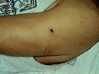 <strong>Puncture Wound - BB Gun</strong> <p>This photo shows a puncture wound from a BB gun in the upper arm. Note the small hole in the arm where the BB struck and entered the skin.</p>