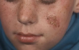 <strong>Impetigo of Left Cheek</strong> <p>This shows impetigo on the face. Impetigo is a skin infection caused by bacteria.   The infection causes a red sores which leak fluid.  This area will then dry and become crusty as it heals.</p>