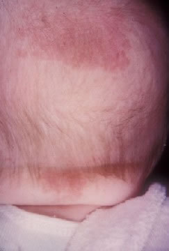 <strong>Stork Bite of Neck and Posterior Scalp</strong> <p>This shows a storkbite which is a birthmark often found in babies.  These birthmarks usually go away on their own.</p><p>Some brief notes about storkbites: </p><ul><li>Flat pink birthmark</li><li>Present in 50% of newborns</li><li>Also called salmon patches</li><li>Most fade by 3 years, but 25% are still present into adulthood</li></ul>
