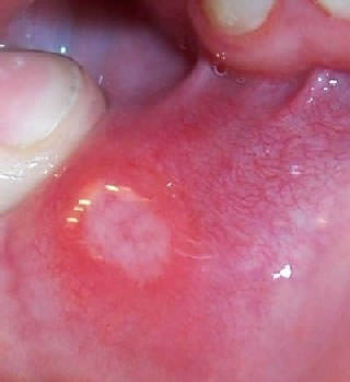 <strong>Canker Sore on Inner Lower Lip</strong> <p>This is a picture of a canker sore on the inner lip. These sores are painful. They can be caused by many things including: injury to the tissue in the mouth, citrus fruits, acidic vegetables and allergic reactions. Some diseases can also cause a canker sore to form.</p>