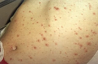 <strong>Chickenpox on Abdomen</strong> <p>The Chickenpox rash can occur on all body surfaces. The rash is raised, red and itchy.</p><p>The rash is no longer contagious when all of the spots are crusted over and no new spots are appearing. This usually takes 7 days after the rash first appears.</p>