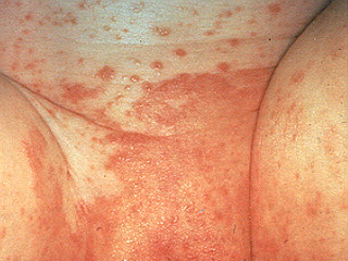 <strong>Diaper Rash</strong> <p>This photo shows a red diaper rash in the area under the diaper. </p><p>Any diaper rash that lasts longer than a couple days can become infected with yeast. Note the red spots outside the main area of redness. </p><p>If a yeast infection is suspected, clotrimazole cream (such as Lotrimin; over-the-counter) should be applied 4 times per day.</p>
