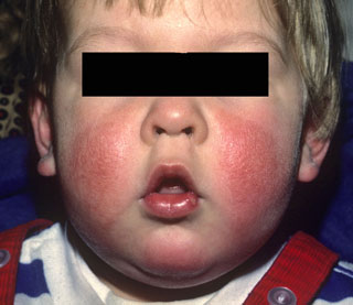 <strong>Eczema-Child</strong> <p>This is how eczema can appear on the cheeks of a child. The skin is red, dry, cracked and swollen. Your child may find it itchy.</p>