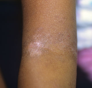 <strong>Eczema - Teen</strong> <p>This shows eczema in the elbow crease of a teen.  The skin is dry and may be itchy. It also shows loss of skin pigment (color), which may happen in people with dark skin. Eczema can cause the skin color to be darker or lighter.</p>