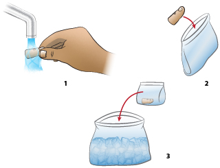 <strong>First Aid - Amputated Finger or Toe - Transport</strong> <ul><li><strong>Step 1</strong>: Briefly rinse amputated part with water (to remove any dirt)</li><li><strong>Step 2</strong>: Place amputated part in plastic bag (to protect and keep clean)</li><li><strong>Step 3</strong>: Place plastic bag containing the part in a container of ice (to keep cool and preserve tissue).</li></ul><p><em>Note</em>: Take patient and amputated part to emergency department immediately.</p>