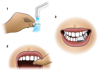 <strong>First Aid - Tooth (Adult)- Replace if Knocked Out</strong> <p>To save the tooth, it must be put back in the socket (re-implanted) as soon as possible. Two hours is the limit for survival of the tooth. Right away is best.</p><p><em>Here are the steps for putting the tooth back in the socket:</em></p><ul><li><strong>Step 1:</strong> Rinse off the tooth with saliva or water. Do not scrub the tooth.</li><li><strong>Step 2:</strong> Place it in the socket facing the correct way. Press down on the tooth with your thumb until the top of the tooth is level with the adjacent tooth.</li><li><strong>Step 3:</strong> Lastly, bite down on a wad of cloth to stabilize the tooth until you can be seen by a dentist. If your dentist is not immediately available, then go to the emergency department (ER).</li></ul><p>If the tooth cannot be put back in its socket: Place the tooth in either milk or saliva to keep it from drying out and go right away to the dentist. Again, If your dentist is not immediately available, then go to the ER.</p><p>Special Notes:</p><ul><li>Even if you get the tooth back in the socket right away, only time will tell whether the tooth will live. It may not.</li><li>Baby teeth cannot be re-implanted.</li></ul>