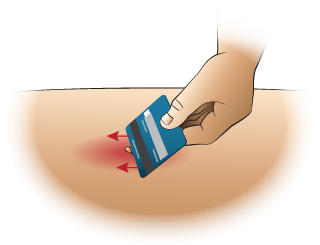 <strong>First Aid - Removing a Stinger</strong> <p>The stinger looks like a tiny black dot in the center of the sting. There are many different methods of removal. Removing the stinger quickly is more important than the method of removal used.</p><ul><li>You can scrape it out with a credit card or finger nail.</li><li>You can also use adhesive tape.</li><li>If only a small fragment remains, don't worry about it. It will shed with the skin.</li></ul><p>Special Notes: </p><ul><li>In many cases no stinger will be present. </li><li>Only bees leave their stingers. Wasps, yellow jackets and hornets do not.</li></ul>