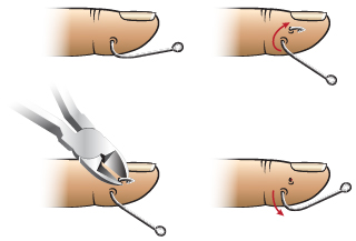 <strong>First Aid - Removing a Fishhook</strong> <p>This method of fishhook removal is sometimes called the <strong>Advance and Cut Method.</strong></p><p>There are four steps in removing a fishhook:</p><ol><li><strong>Step 1. </strong>Using pliers (or needle drivers) firmly grasp the hook.</li><li><strong>Step 2. </strong>Push (advance) the hook until the tip of the hook pops out through the skin.</li><li><strong>Step 3. </strong>Cut off the tip of the hook and the barb.</li><li><strong>Step 4. </strong>Back out the hook out.</li></ol><p><em>Important Note: </em></p><ul><li>Use these instructions when you can't get into see a doctor right away. Most of the time, it is best to have a doctor (or other health care provider) remove a fishhook.</li><li>The hook in this drawing has only a single barb at the tip, so the tip of the hook (with the barb) can be cut off and the hook pulled backwards through the skin.</li><li>Some hooks can have more than one barb. In such cases, it is better to cut off the ring at the bottom of the hook and push the hook all of the way through the skin.</li></ul>