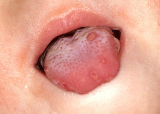<strong>Hand-Foot-and-Mouth Disease (tongue)</strong> <p>This is what hand-foot-and-mouth disease looks like on the tongue.  There are sores or blisters on the tongue.  Make sure to wash hands often to prevent the spread of the disease.</p>