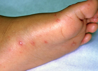 <strong>Hand-Foot-and-Mouth Disease (foot)</strong> <p>This shows the sores or blisters from hand-foot-and-mouth disease on the foot.  Make sure to wash hands often to prevent the spread of the disease.</p>