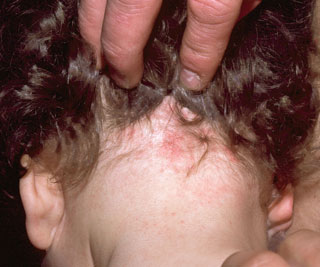 <strong>Head Lice Reaction</strong> <p>This shows an allergic reaction to the saliva of a louse (a louse is one lice).  It makes the skin itchy and red.</p>