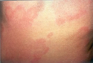 <strong>Hives on the Back</strong> <ul><li>Hives is an itchy rash. </li><li>The shapes of hives vary. Sizes of hives vary from ½ inch to several inches across. </li><li>Hives may disappear in one area and then reappear somewhere else, over the course of several hours. </li></ul>