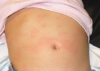 <strong>Hives on the Abdomen</strong> <ul><li>Hives is an itchy rash. </li><li>The shapes of hives vary. Sizes of hives vary from ½ inch to several inches across. </li><li>Hives may disappear in one area and then reappear somewhere else, over the course of several hours. </li></ul>