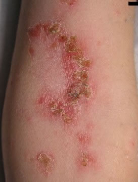 <strong>Impetigo of Elbow</strong> <p>This shows impetigo on the elbow. Impetigo is a skin infection caused by bacteria. The infection causes a red sore which leaks fluid. This area will then dry and become crusty as it heals.</p>