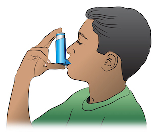 <strong>How to Use a MDI</strong> <p>A <strong>metered dose inhaler (MDI)</strong> is a device used to deliver asthma medicine into the lungs. To  be sure to deliver the medicine effectively, use the following steps:</p><ul><li>STEP 1 - Remove the cap and shake the inhaler.</li><li>STEP 2 - Hold the inhaler about 1-2 inches in front of the mouth. Breathe out - completely.</li><li>STEP 3 - Press down on the inhaler to release the medicine as you start to breathe in slowly.</li><li>STEP 4 - Breathe in slowly for three to five seconds.</li><li>STEP 5 - Hold your breath for ten seconds to allow the medicine to reach deeply into your lungs.</li><li>If your doctor has prescribed two puffs, wait 1 minute and then repeat steps 2-5.</li></ul>