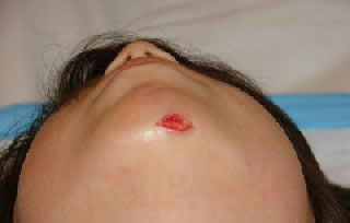 <strong>Laceration - Chin</strong> <p>This photo shows a gaping laceration (cut) of the chin. It will require closure with either sutures or skin glue (such as Dermabond).</p><p>First Aid Care Advice:</p><ul><li>Apply direct pressure for 10 minutes to stop any bleeding.</li><li>Wash the cut with soap and water.</li><li>Once the bleeding has stopped, cover with a gauze dressing or adhesive bandage.</li></ul>