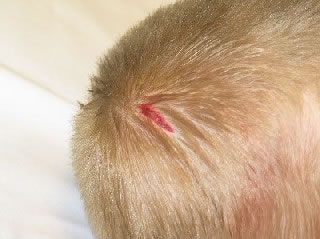 <strong>Laceration - Scalp</strong> <p>This scalp laceration (cut) is gaping open. It will require closure with sutures or medical staples. </p><p>First Aid Care Advice:</p><ul><li>Apply direct pressure for 10 minutes to stop any bleeding.</li><li>Wash the cut with soap and water.</li></ul>