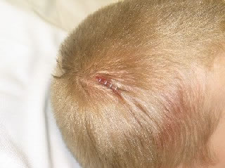 <strong>Laceration - Scalp (After Staples)</strong> <p>This photo shows a scalp laceration after it has been closed with 4 metal medical staples. </p>