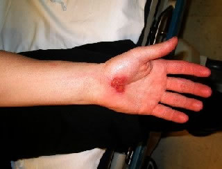 <strong>Lymphangitis - Left Forearm</strong> <p>If you look closely at this photo, you should be able to see a red streak (lymphangitis) spreading from the hand wound up into the arm.</p><p>The presence of lymphangitis means that there is an infection that needs urgent antibiotic treatment. It may require a hospital stay for treatment.</p>
