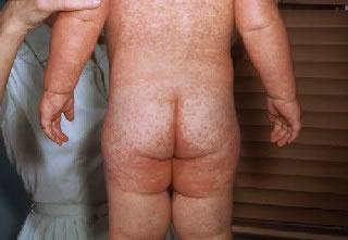 <strong>Measles Rash</strong> <p>This child with measles is showing the common red blotchy rash on his buttocks and back. It is the 3rd day of the rash.</p><p>Measles is a very contagious viral disease. Symptoms include fever, red eyes, runny nose, cough, and spots on the inside cheeks. </p><p>A red blotchy rash appears around day 3 of the illness, first on the face, and then on other areas.</p>