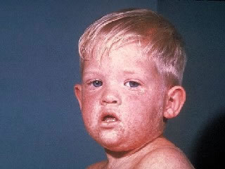 <strong>Measles Rash on Face</strong> <p>This photo shows a child with measles.</p><p>Measles is a very contagious disease. It is caused by a virus. Symptoms include fever, red eyes, runny nose, cough, and spots on the inside cheeks (inside of mouth). A red, blotchy rash appears around day 3 of the illness. It first appears on the face and then spreads to other areas.</p>