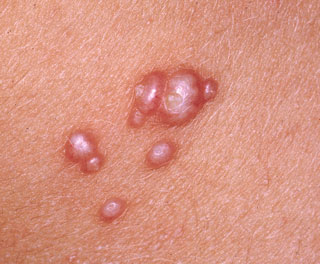 <strong>Molluscum Contagiosum</strong> <p>This shows an infection from the molluscum contagiosum virus. Molluscum is sometimes called a "water wart." The growths are pink, white or pearly-colored. They are firm, small and raised with a dimple in the middle.</p>