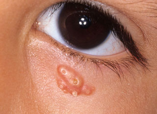 <strong>Molluscum Contagiosum - Eye</strong> <p>This shows an eye with an infection from the molluscum contagiosum virus. The growths are pink, white or pearly-colored. They are firm, small and raised with a dimple in the middle.</p>