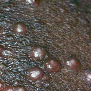 <strong>Molluscum</strong> <p>This shows an infection from the molluscum contagiosum virus. Molluscum is sometimes called a "water wart." The growths are pink, white or pearly-colored. They are firm, small and raised with a dimple in the middle.</p>