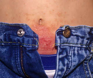 <strong>Nickel Allergy Rash - Abdomen</strong> <p>This shows a rash that was caused from the skin touching the snap on the jeans.  This person is allergic to the nickel in the snap. The area is red and crusty.</p>