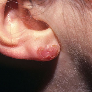 <strong>Allergic Reaction to Nickel - Ear Lobe</strong> <p>This shows a rash that was caused from a nickel allergy.  The allergic rash is from the nickel (metal) in the earring. It is red, crusty and moist.</p>
