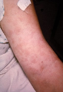 <strong>Penicillin Rash on the Arm</strong> <p>This patient had a widespread rash from an allergy to penicillin. The picture shows the arm.</p>