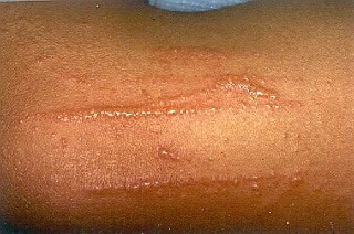 <strong>Poison Ivy Rash on Forearm</strong> <p>The oil from the plant leaves irritates the skin. </p><p>The redness and blistering from the rash often appears in streaks or lines, because the leaf brushes across the body in a line as a person walks past. </p>