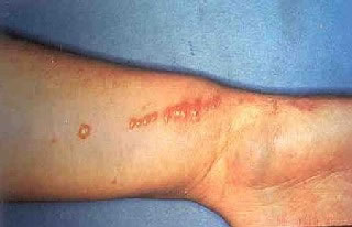 <strong>Poison Ivy Rash on Wrist</strong> <p>The oil from the plant leaves irritates the skin. </p><p>The redness and blistering from the rash is often arranged in streaks or lines, because the leaf brushes across the body in a line as a person walks past. </p>