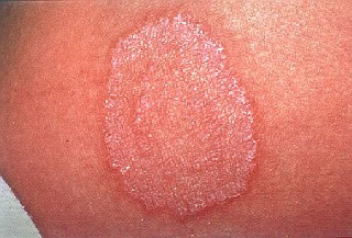<strong>Ringworm Rash on Arm</strong> <p>This is a picture of ringworm. The area is round and pink. It has a raised, rough scaly border. The ring slowly grows in size. It is often slightly itchy.</p><p>This is caused by a fungus, not a worm. It can be passed from person to person.  If you notice a rash like this, contact your doctor for treatment.</p>
