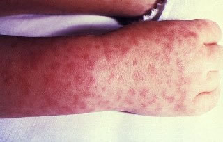 <strong>Rocky Mountain Spotted Fever</strong> <p>This child's right hand and wrist show the spotted rash of Rocky Mountain spotted fever.</p><p>Rocky Mountain spotted fever is caused by a bacteria. The disease is spread by ticks.</p>