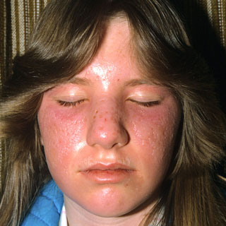 <strong>Sunburn - Second Degree</strong> <p>This shows a second degree burn on the face.  The area is red, raised and blistered.</p>