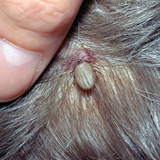 <strong>Tick on Scalp</strong> <p>This shows a tick feeding on the scalp.</p>