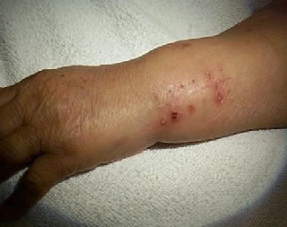 <strong>Wound Infection - Suture Site</strong> <p>There is a pimple where a stitch comes through the skin. The pimple suggests a low-grade infection.</p>
